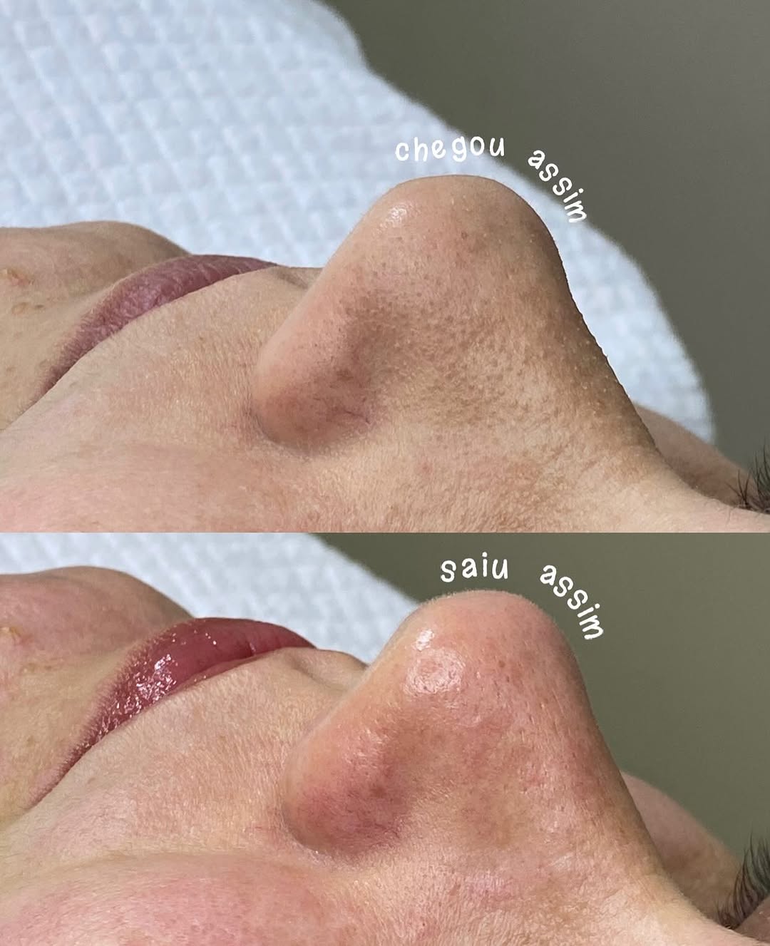 Resultado limpeza de pele 1